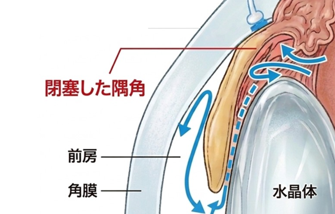 閉塞隅角のイメージ