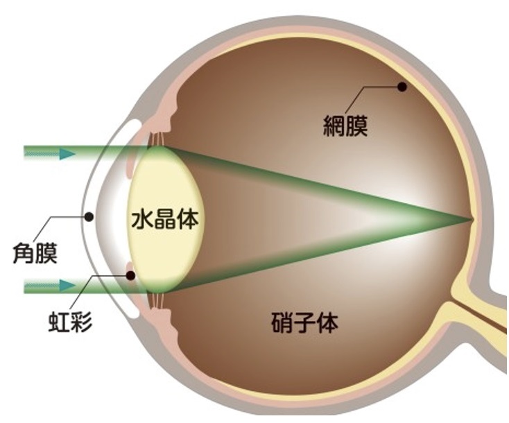 白内障とは